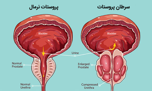 تشخیص سرطان پروستات